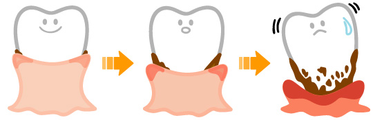 歯周病が進行するイラスト