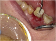 骨の充填材を入れた状態