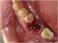 歯肉を縫合した状態