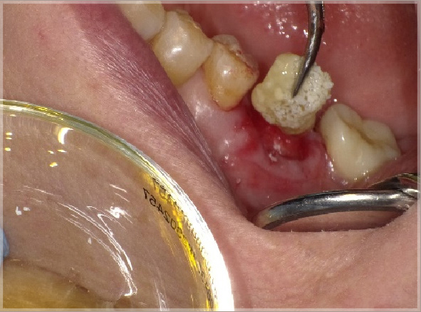 骨の充填材を入れた状態