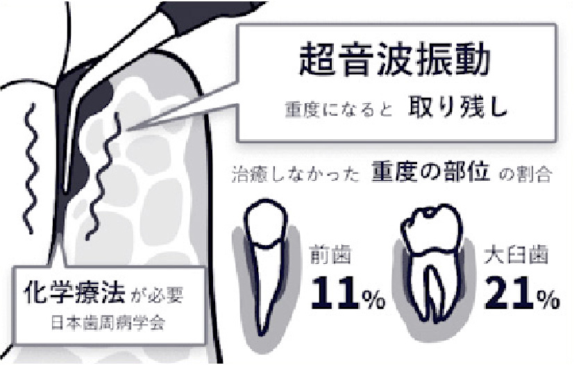 超音波振動 重度になると取り残し。治療しなかった重度の部位の割合、前歯11%、大臼歯21%。化学療法が必要（日本歯周病学会）