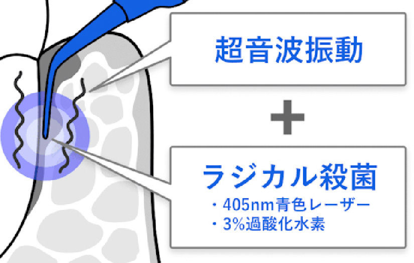 超音波振動+ラジカル殺菌・405nm青色でレーザー、3%過酸化水素