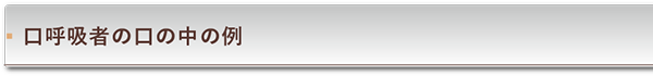 口呼吸者の口の中の例