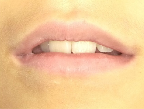 口呼吸の口（お口ぽかん）1