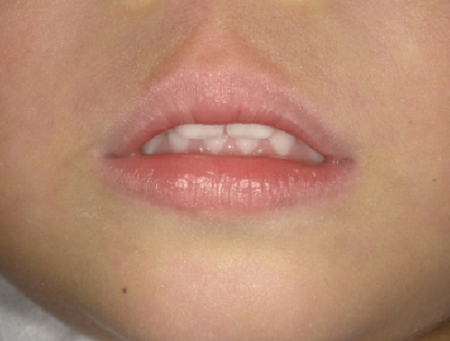 口呼吸の口（お口ぽかん）2