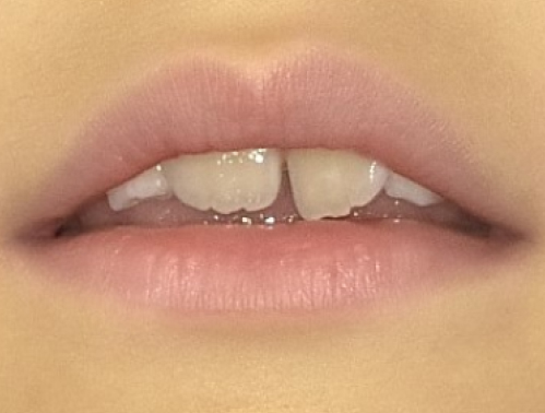 口呼吸の口（お口ぽかん）3