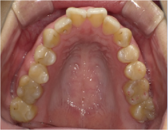 狭窄歯列（高口蓋）