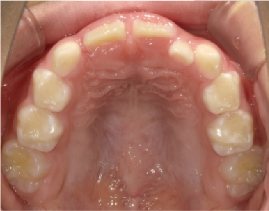 狭窄歯列（高口蓋）