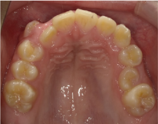 狭窄歯列（高口蓋）