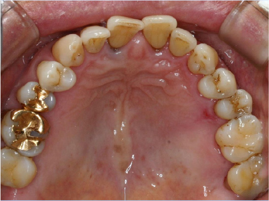 狭窄歯列（高口蓋）