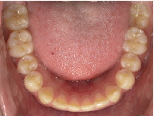 正常な位置の舌