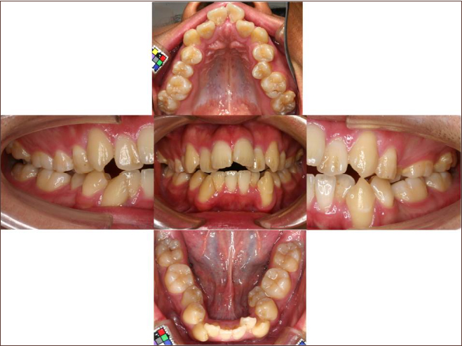 口呼吸者の口の中