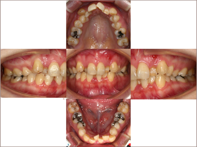 口呼吸者の口の中