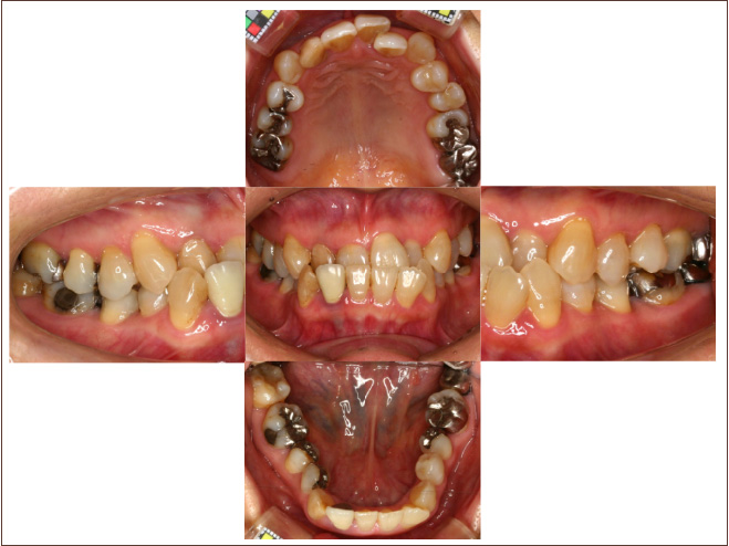 口呼吸者の口の中