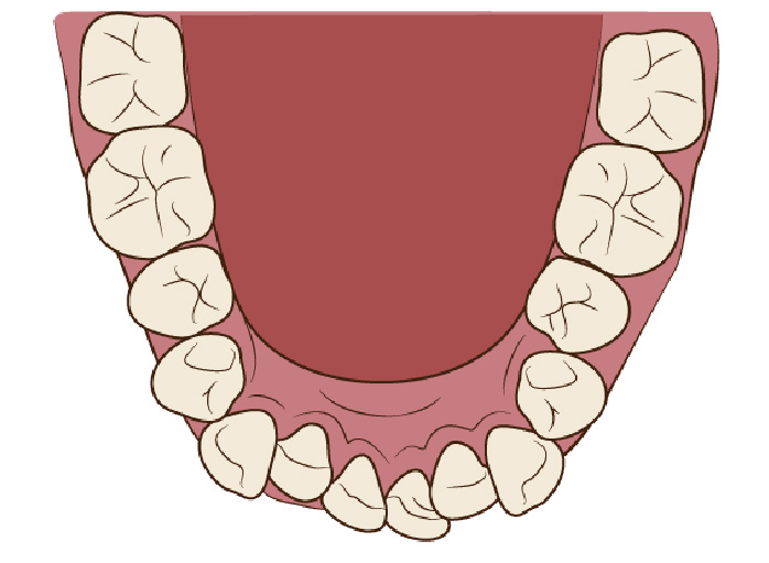 口呼吸者の口の中