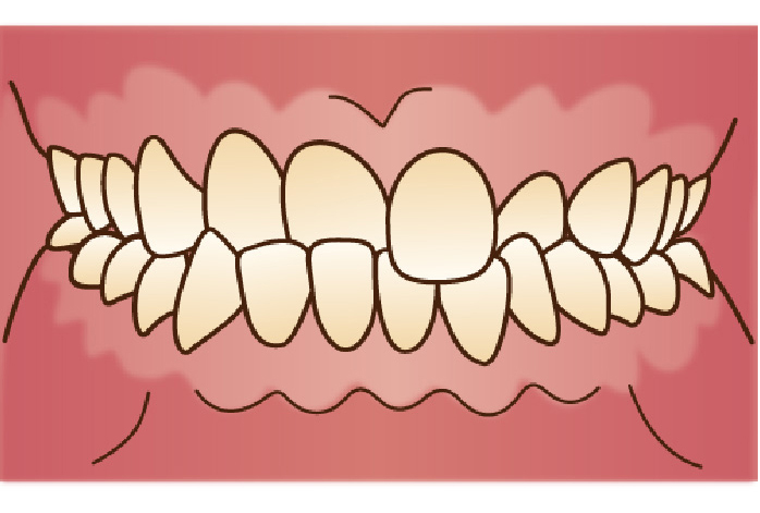 口呼吸者の口の中